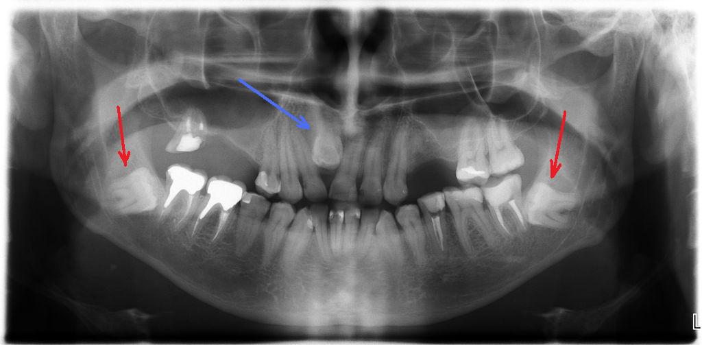 Рентгеновский снимок зубов мудрости, растущих неправильно / ©Flickr