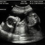 Теория черепа эмбриона: миф или реальность?