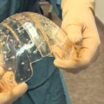 Девушке пересадили череп, распечатанный на 3D-принтере