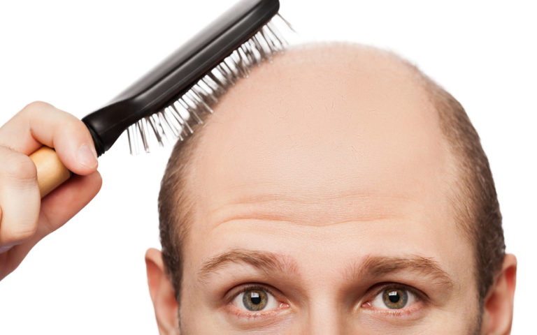 new-cure-for-baldness-ftr