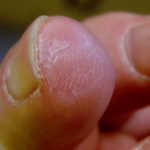 Пациенту вырастили новый палец на основе мочевого пузыря свиньи