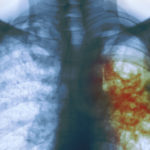 Ученые объяснили особую опасность «русского» туберкулеза
