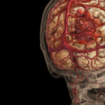Микроинфаркт мозга связали с риском деменции