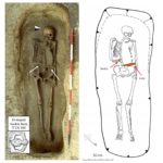 В Италии нашли скелет средневекового мужчины, руку которого заменял нож