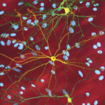 Исследователи описали, как нейроны перестают взаимодействовать при болезни Хантингтона
