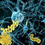 Для борьбы с болезнью Альцгеймера ученые «окунут» мозги пациентов в полезные гены