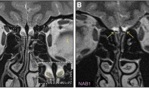 Слева — МРТ нормального мозга; справа — МРТ мозга девушки без обонятельных луковиц