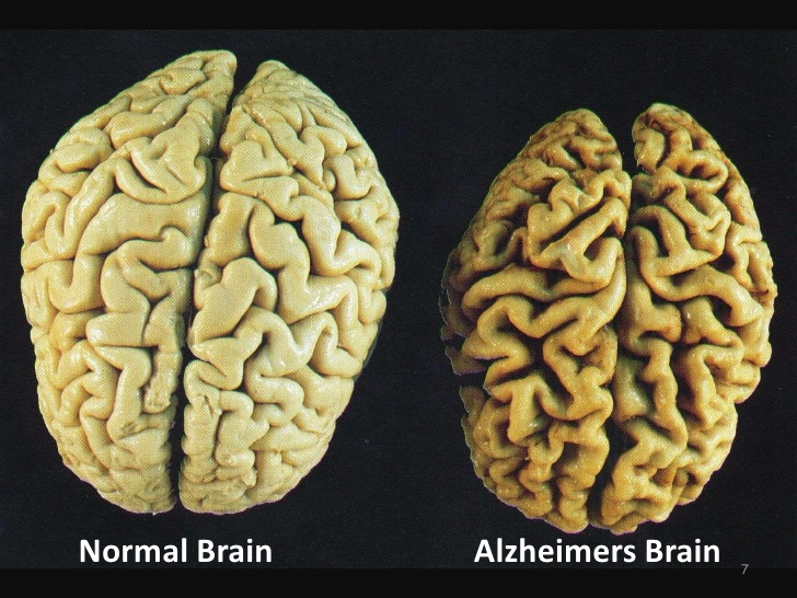 Левый - нормальный мозг, правый - мозг - человека с болезнью Альцгеймера / © www.dementiacarecentral.com