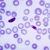 Мазок крови больного малярией