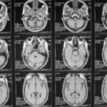 В ТГУ смогли «вживую» увидеть, как организм лечит мозг после инсульта