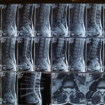В ДВФУ разработали новый метод лечения травмы спинного мозга с помощью нейромодуляции