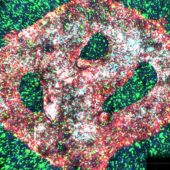 На микрофотографии распечатанной опухоли видны сосуды (красные), клетки микроглии (зеленые) и самой глиобластомы (синие)