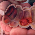 Обнаружена связь между бактериями полости рта и раком кишечника