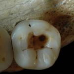 Ученые выяснили, как лечили зубы в каменном веке
