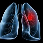 Ученые определили мутации, которые развивают у некурящих рак легких
