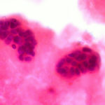 Наноагенты посадят раковую опухоль на «голодный паек»