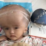 В Китае провели первую в мире операцию по уменьшению головы