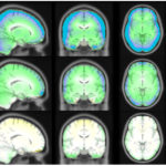 Мозг зависимых научат оставаться «в завязке»