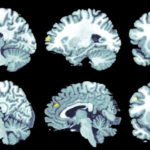 Раннюю диагностику болезни Альцгеймера уточнили с помощью глубокого обучения