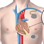 В США представили «имплантат-рисинку» от сердечной недостаточности