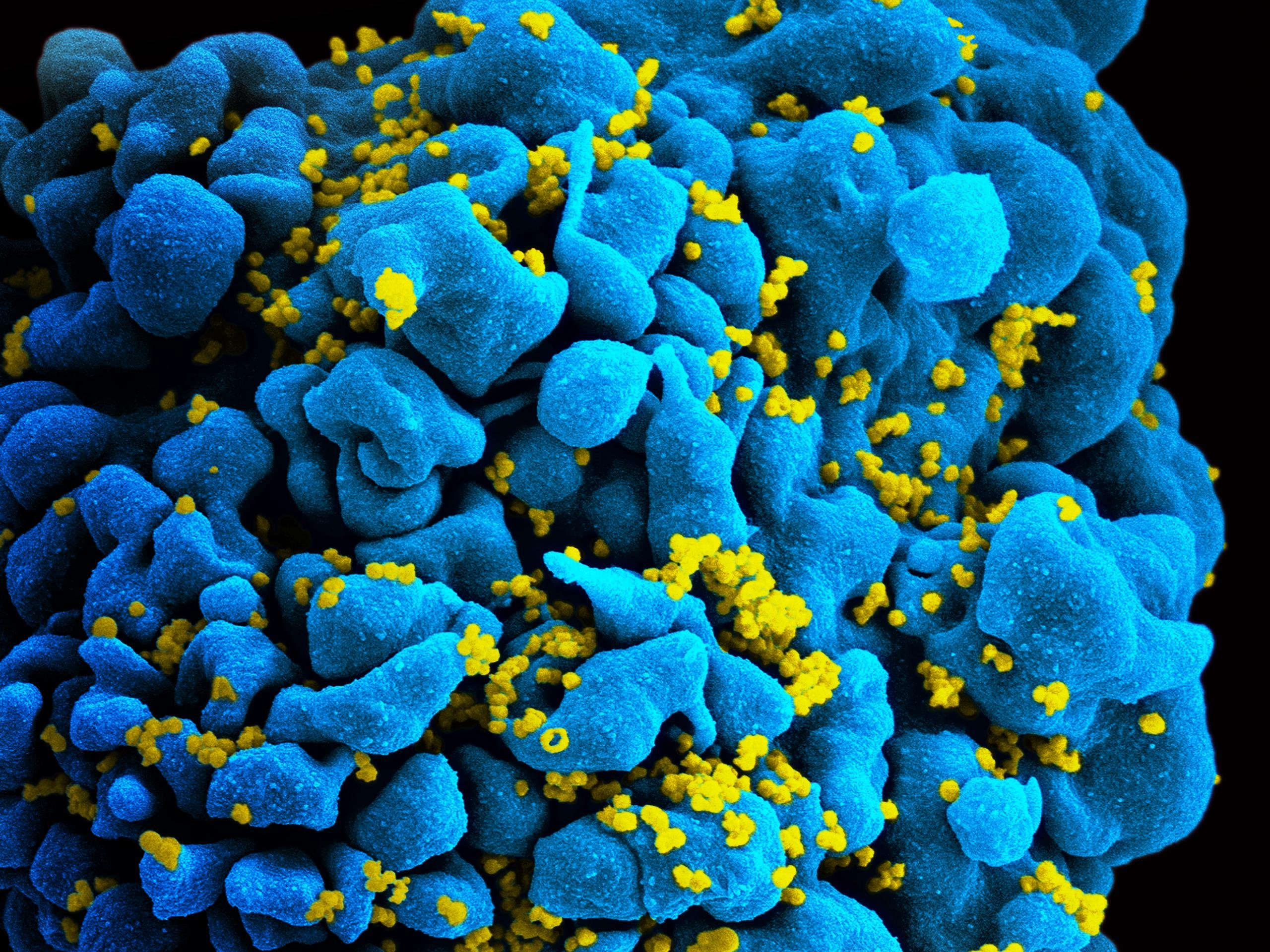 hiv-infected_t_cell_6813384933