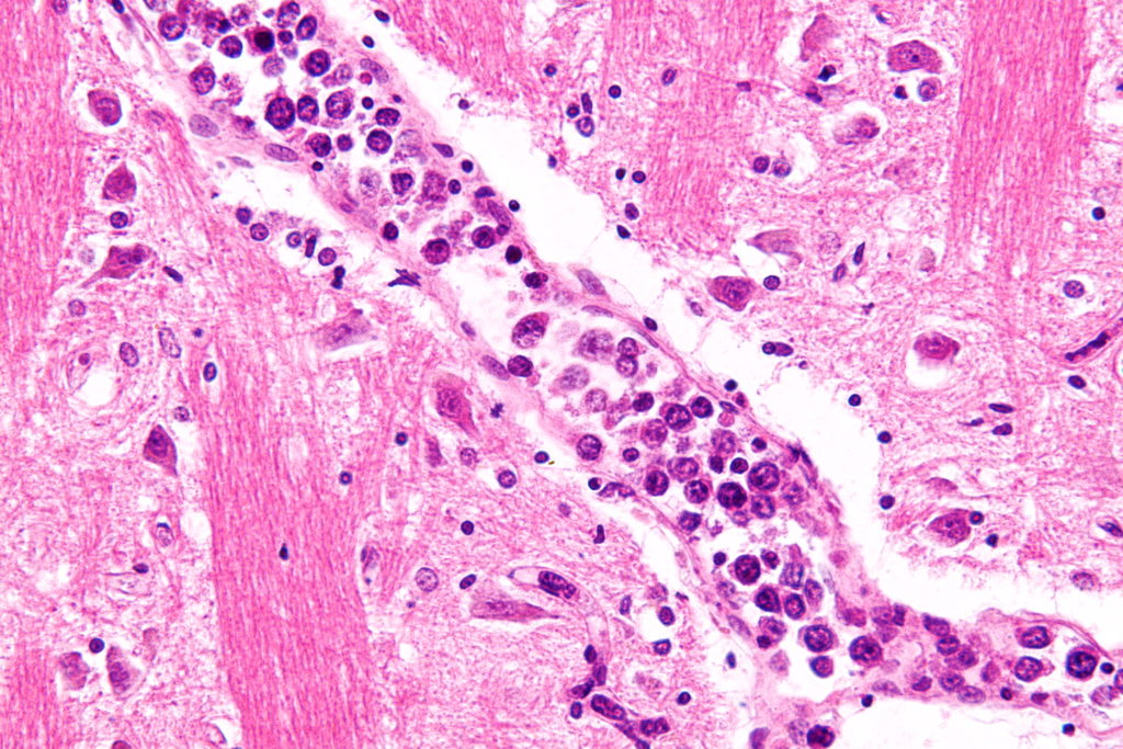 intravascular_lymphoma_-_very_high_mag