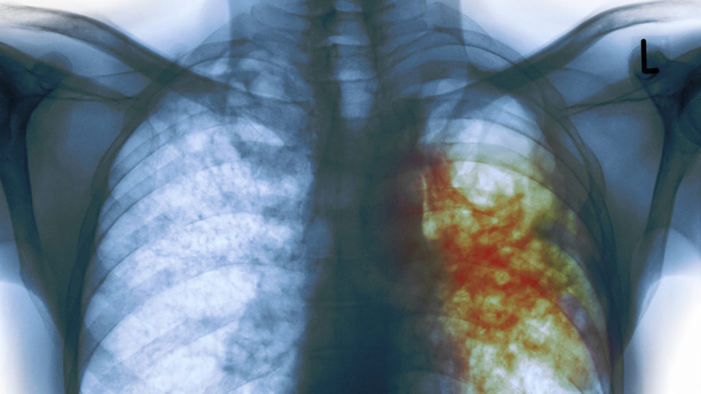 tuberculosis_wide-abf6ee0c49796fb42ff0f302a18483bbd3e2ac15