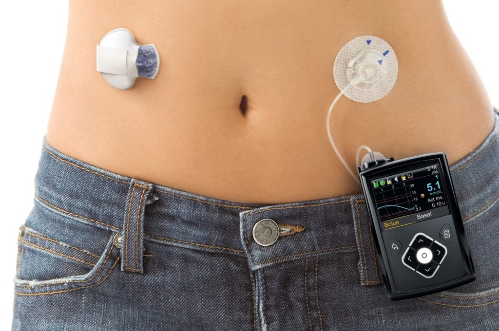 artificial-pancreas-medtronic-fda-medtech