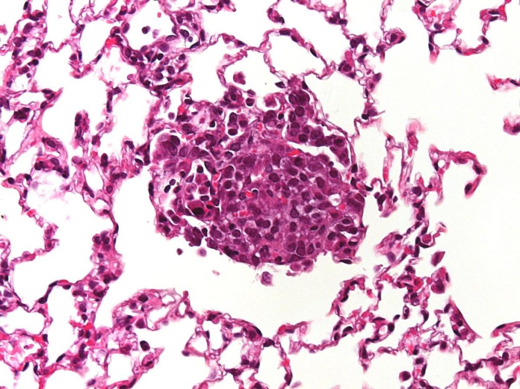 capr-operations-model-melanoma-image