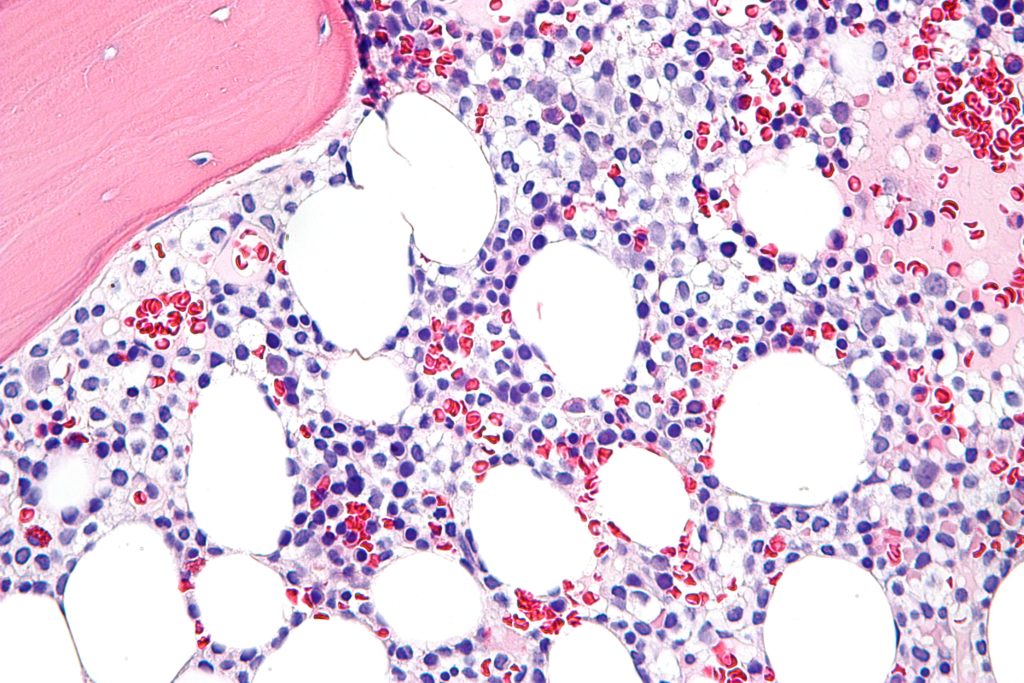 hairy_cell_leukemia_-_very_high_mag