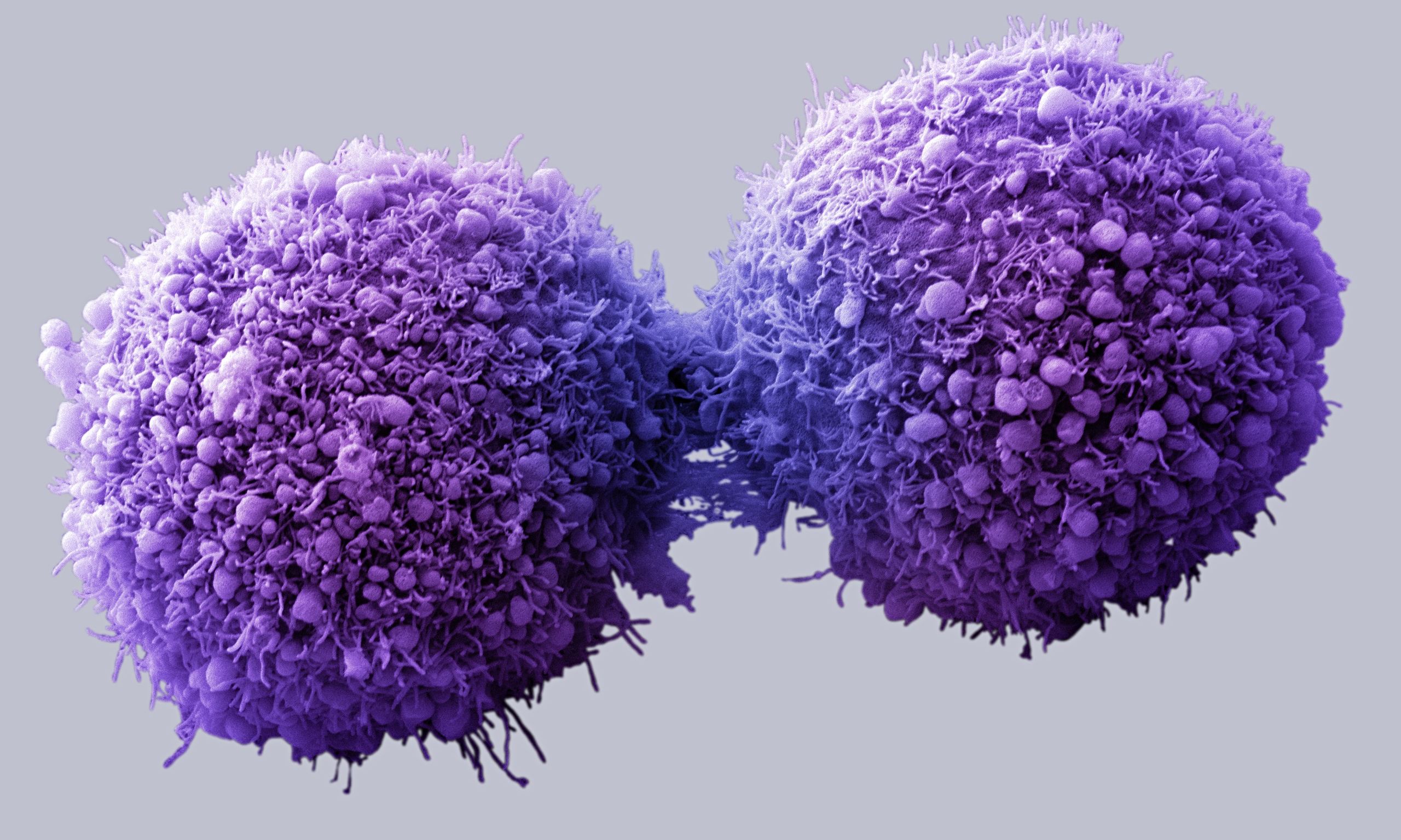 pancreatic-cancer-cells-014