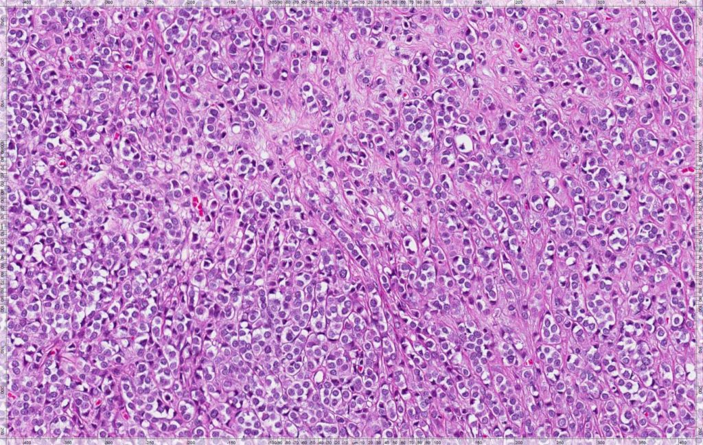 lobularbreastcancer