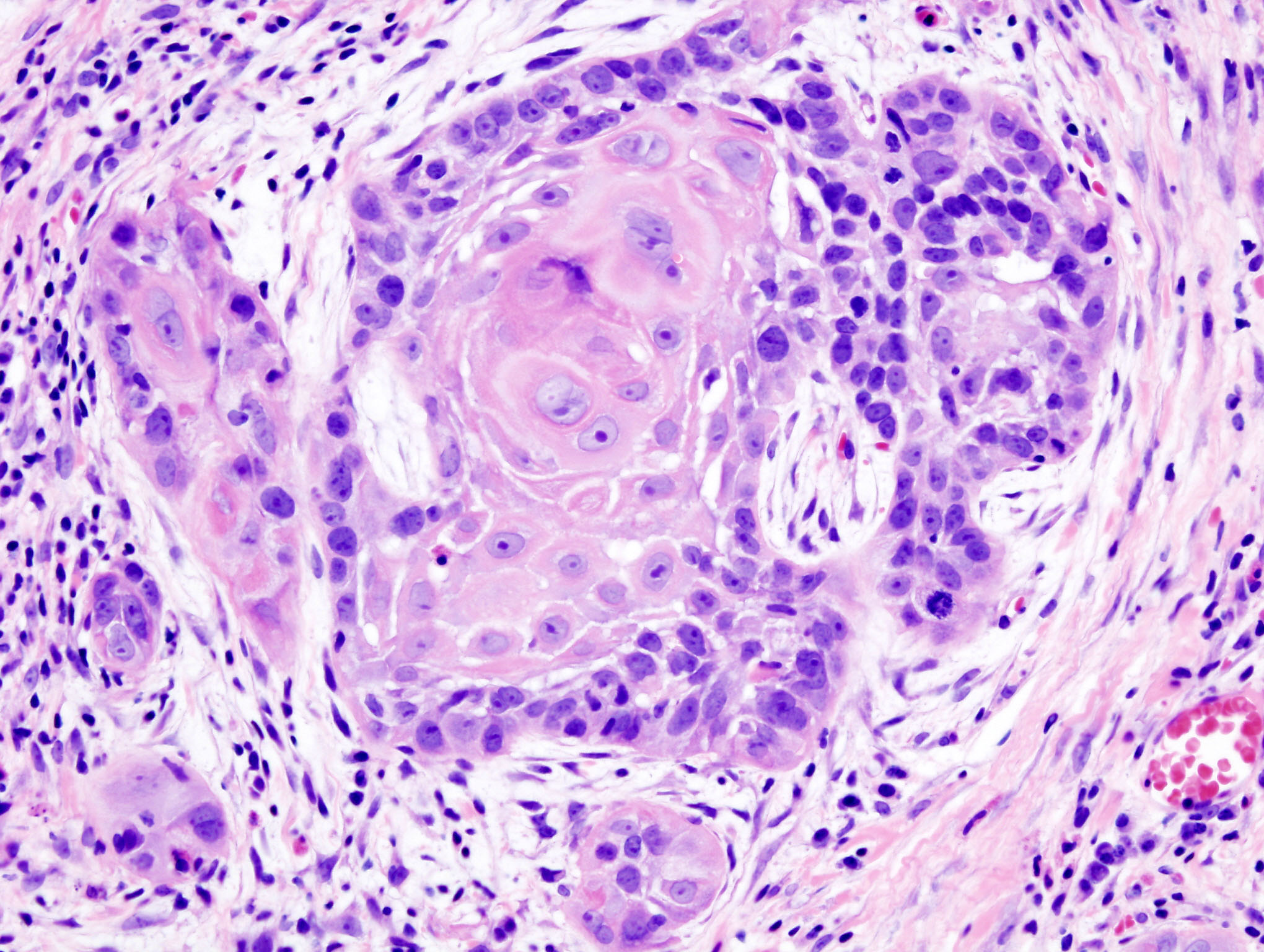 oral_cancer_1_squamous_cell_carcinoma_histopathology