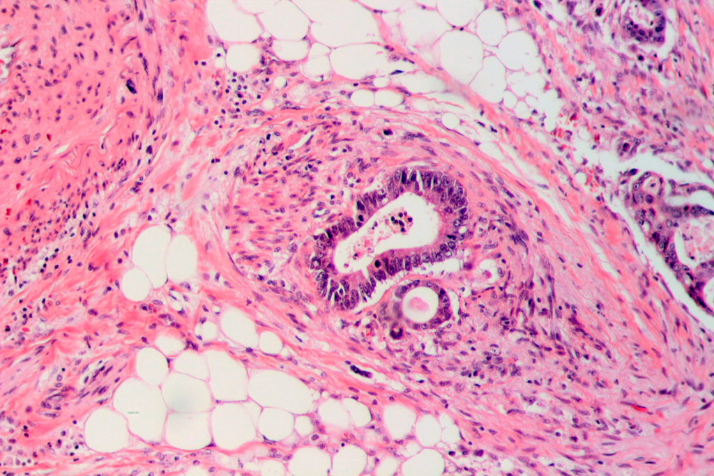 tumor_invasion_into_vein_in_a_case_of_colorectal_cancer_he_2