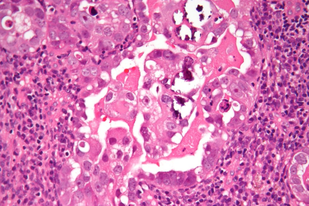 uterine_serous_carcinoma_high_mag