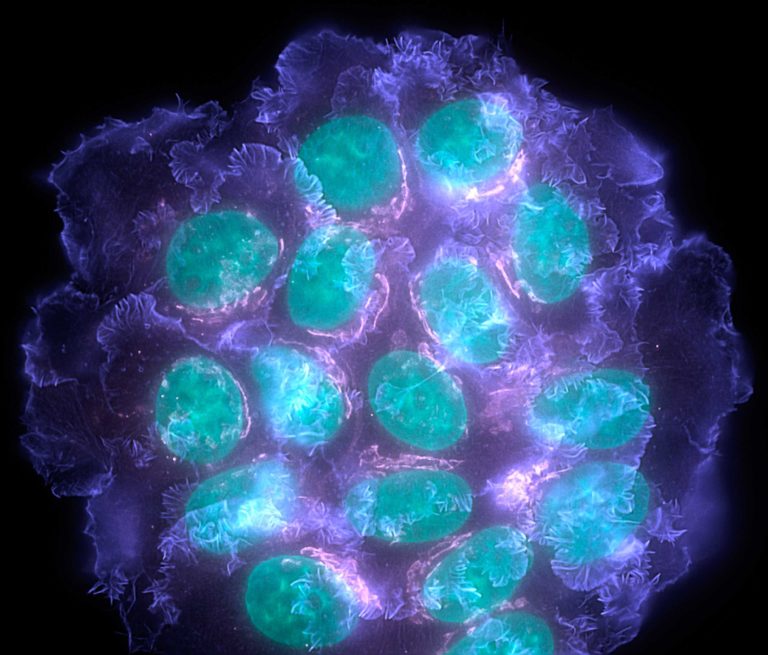 breast-cancer-cells-data