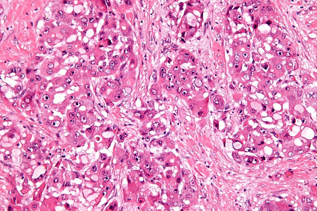 fibrolamellar_hepatocellular_carcinoma_-2-_high_mag