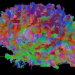 Сотрясение мозга связали с риском болезни Альцгеймера