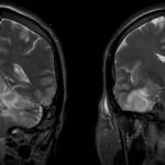 Уменьшение мозга при биполярном расстройстве локализовали