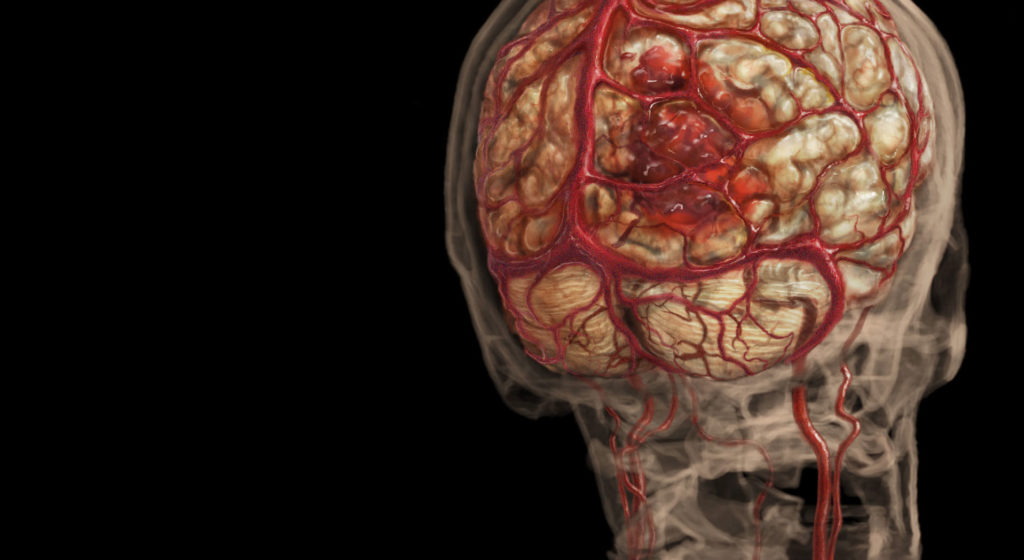 how-stroke-occurs