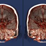 Ученые нашли способ защититься от рака мозга