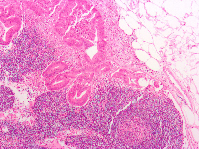 colon-cancer-cells