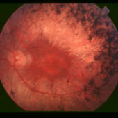 fundus_of_patient_with_retinitis_pigmentosa_mid_stage