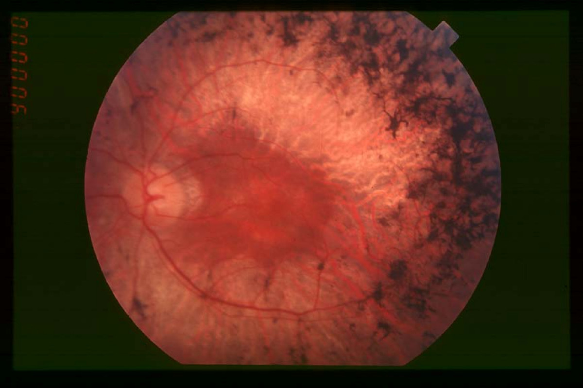 fundus_of_patient_with_retinitis_pigmentosa_mid_stage