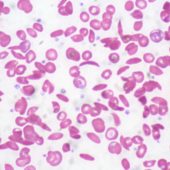 sickle_cell_anemia_5610746554