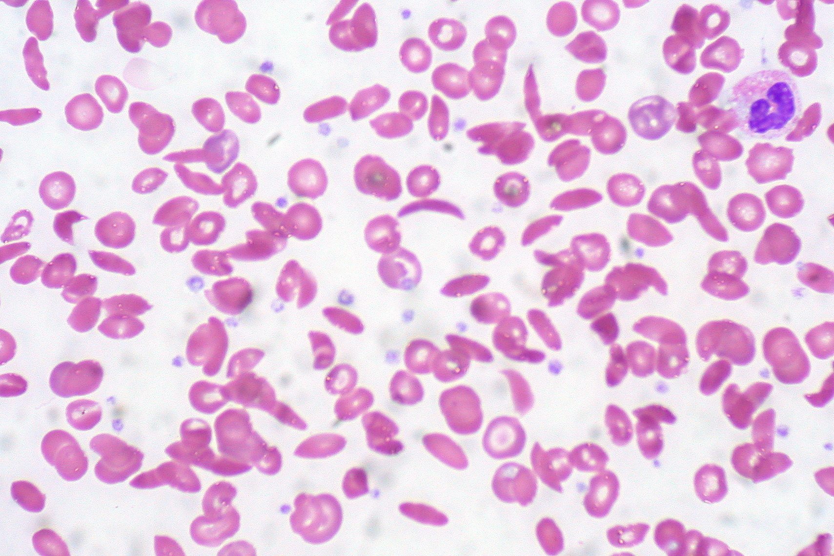 sickle_cell_anemia_5610746554