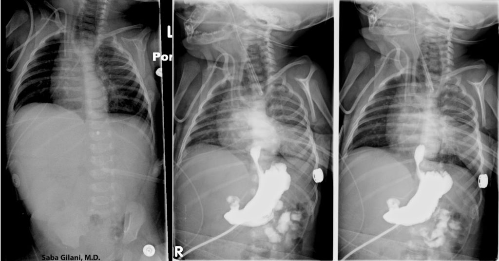 esophageal_atresia_2_copy