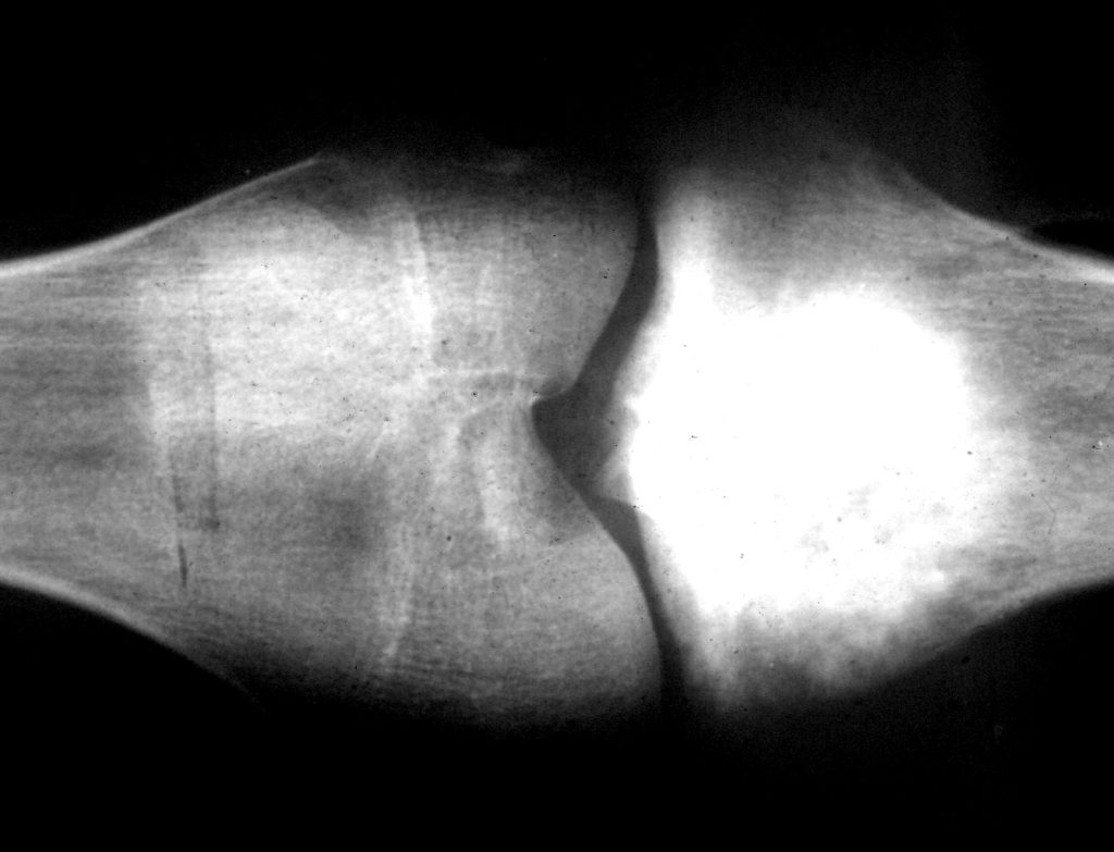 osteosarcoma_blastic_type_xray