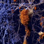 f0117797-brain_nerve_cells_affected_by_alzheimers-spl
