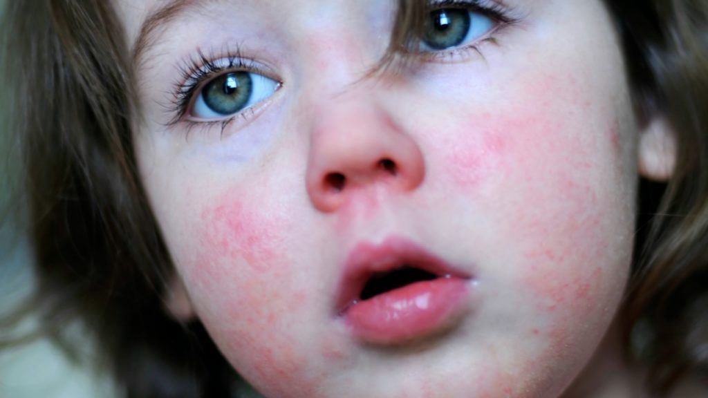 scarlet-fever-outbreak